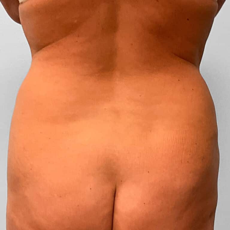 After Image: Mini Tummy Tuck & Lipo – Dr. Tucker - back