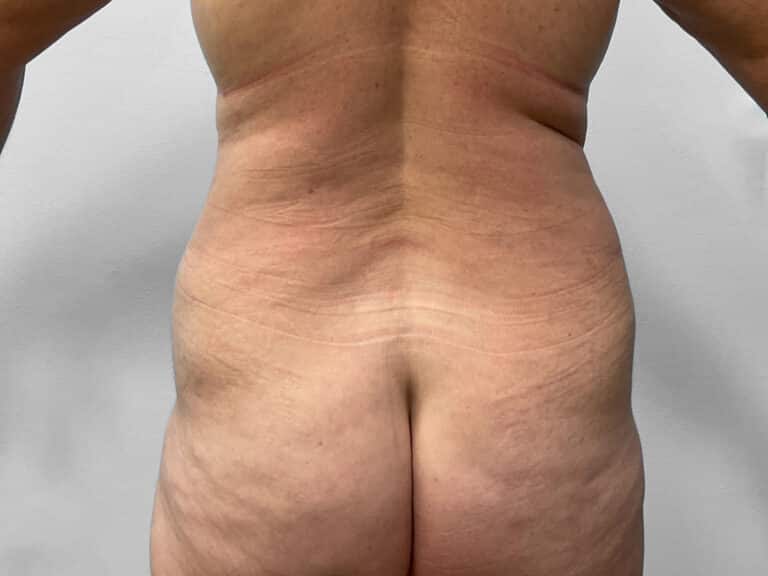 After Image: Tummy Tuck & Lipo – Dr. Tucker - back