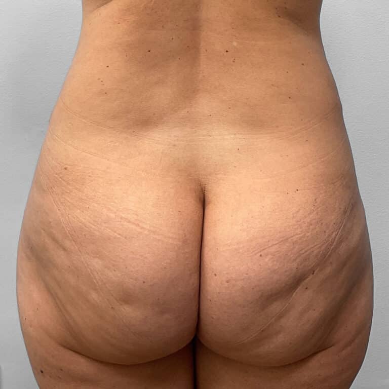 After Image: Tummy Tuck & Lipo – Dr. Tucker - back