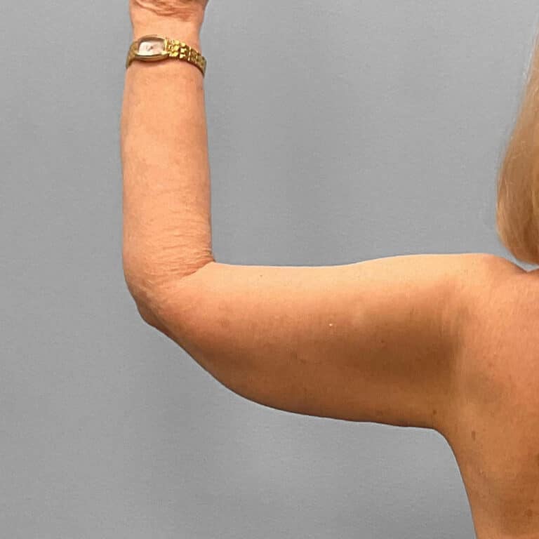 After Image: Arm Lift – Dr. Tucker - back