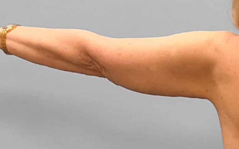 After Image: Arm Lift – Dr. Tucker - back