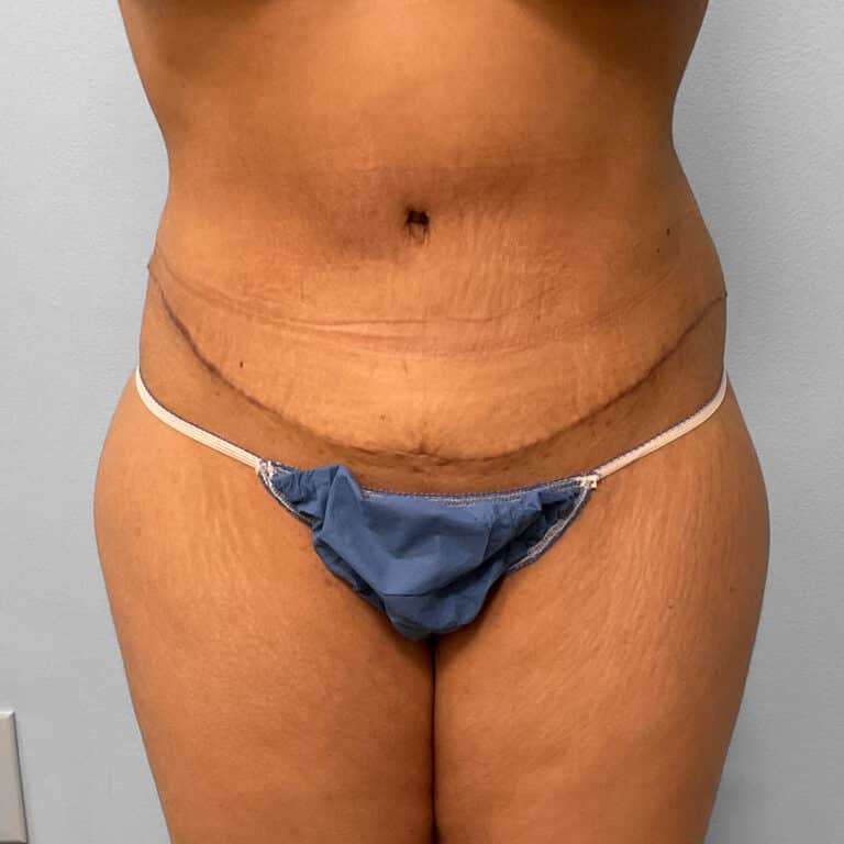 After Image: Abdominoplasty & Lipo Dr. Tucker - front