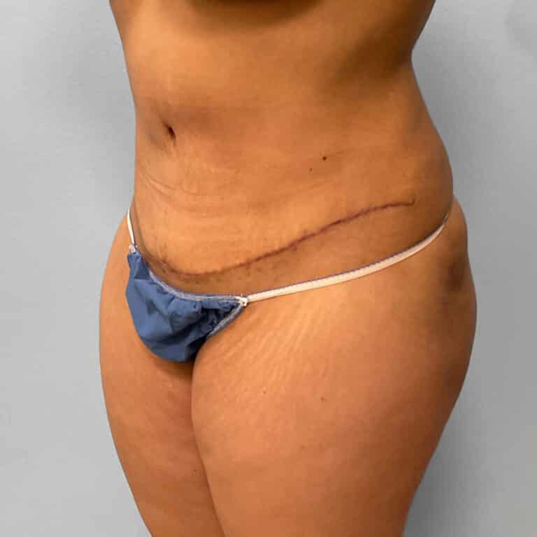 After Image: Abdominoplasty & Lipo Dr. Tucker - left-front-oblique