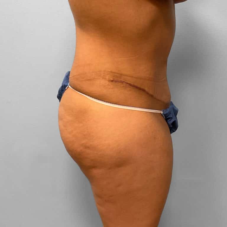 After Image: Abdominoplasty & Lipo Dr. Tucker - right-side