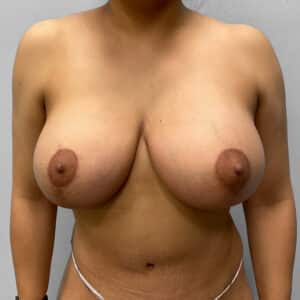 After Image: Breast Augmentation – Dr. Tucker