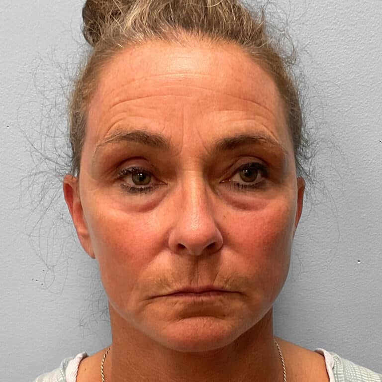 After Image: Facelift, Browlift, TFX – Dr. Tucker - front