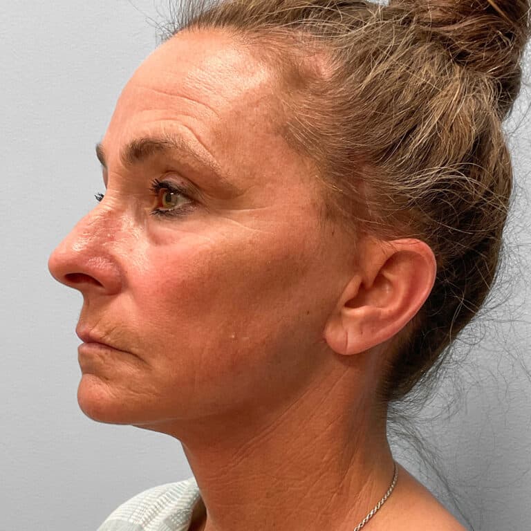 After Image: Facelift, Browlift, TFX – Dr. Tucker - left-front-oblique