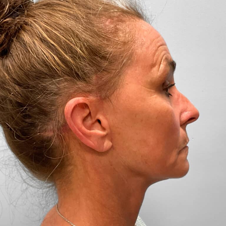 After Image: Facelift, Browlift, TFX – Dr. Tucker - right-side
