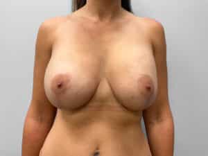 After Image: Breast Augmentation & Lift – Dr. Tucker