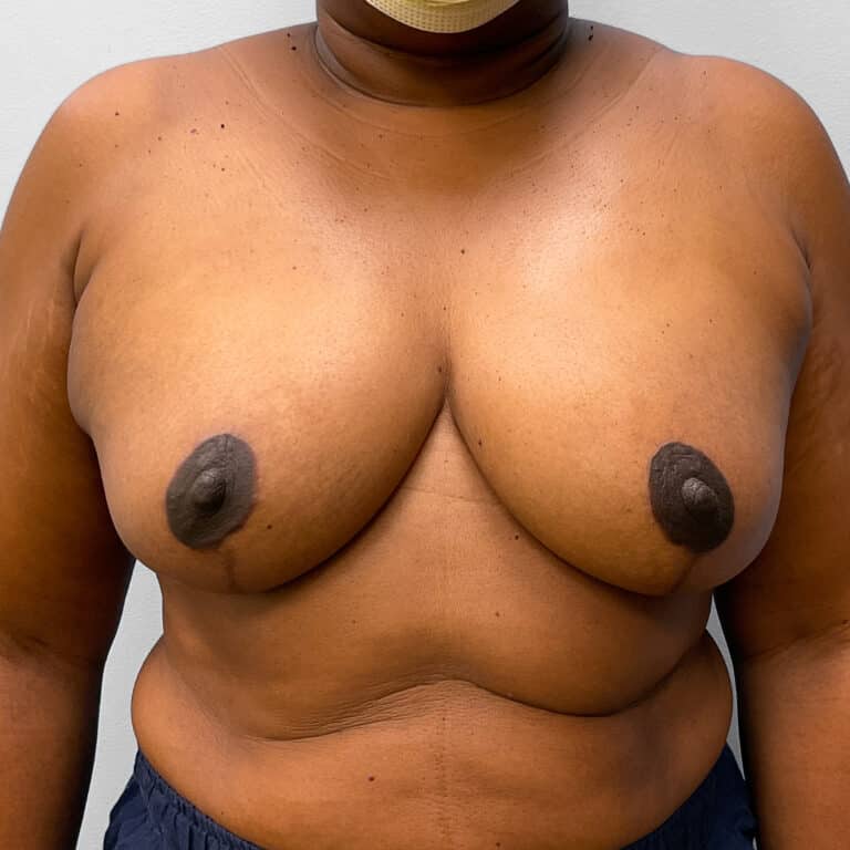 After Image: Breast Augmentation – Dr. Tucker - front