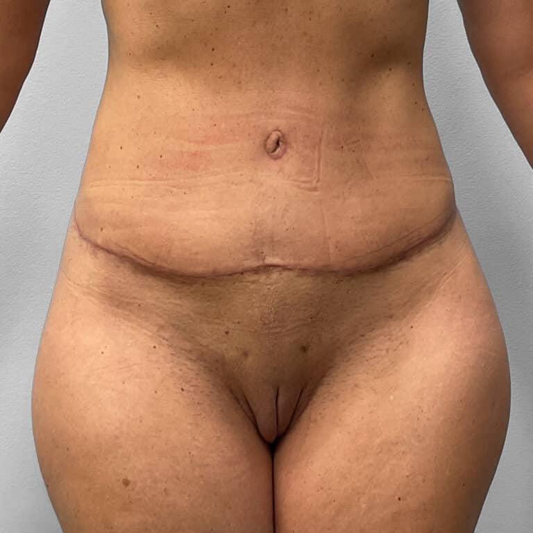 After Image: Tummy Tuck & Lipo – Dr. Tucker - front