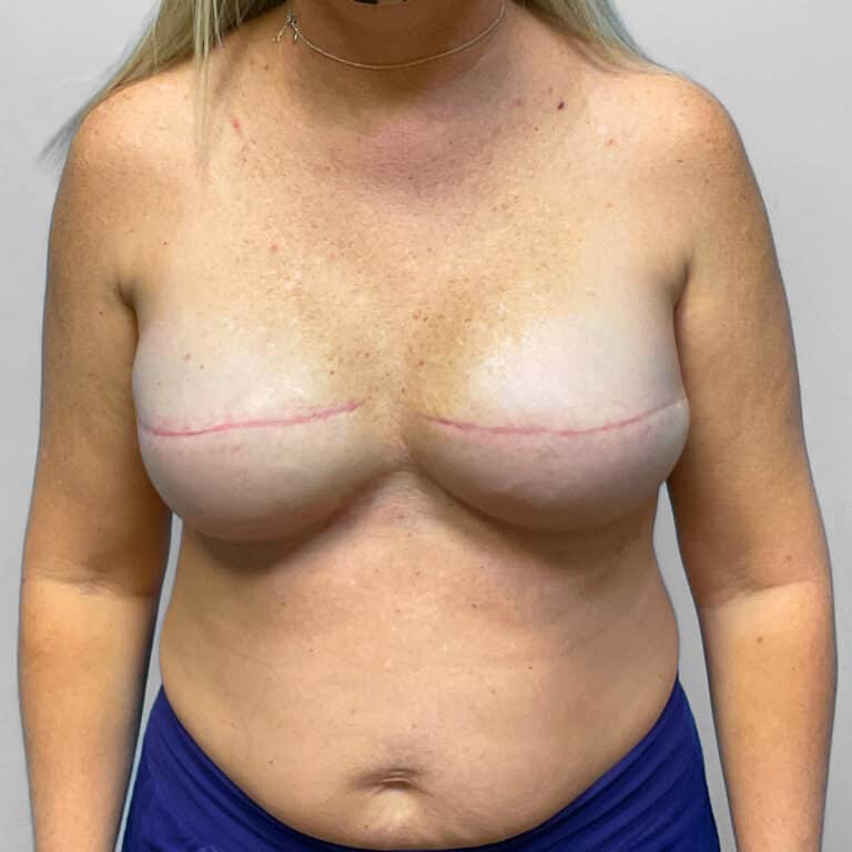 After Image: Breast Reconstruction – Dr. Tucker - front