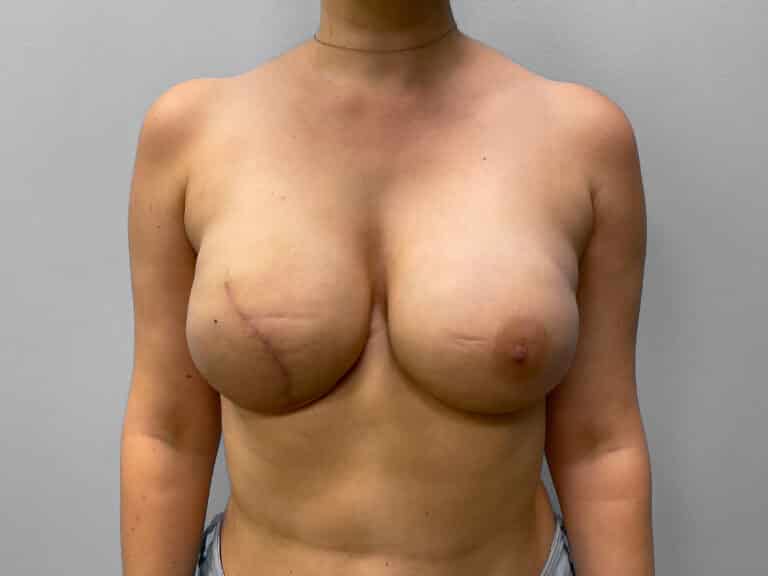 After Image: Breast Reconstruction – Dr. Tucker - front