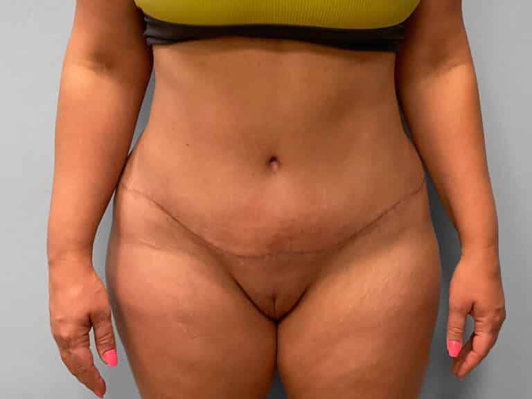 After Image: Abdominoplasty & Lipo – Dr. Tucker - front