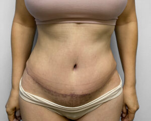 After Image: Tummy Tuck, BBL, & Lipo – Dr. Tucker
