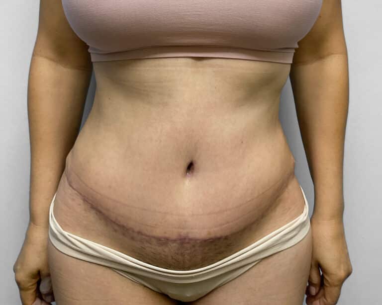 After Image: Tummy Tuck, BBL, & Lipo – Dr. Tucker - front