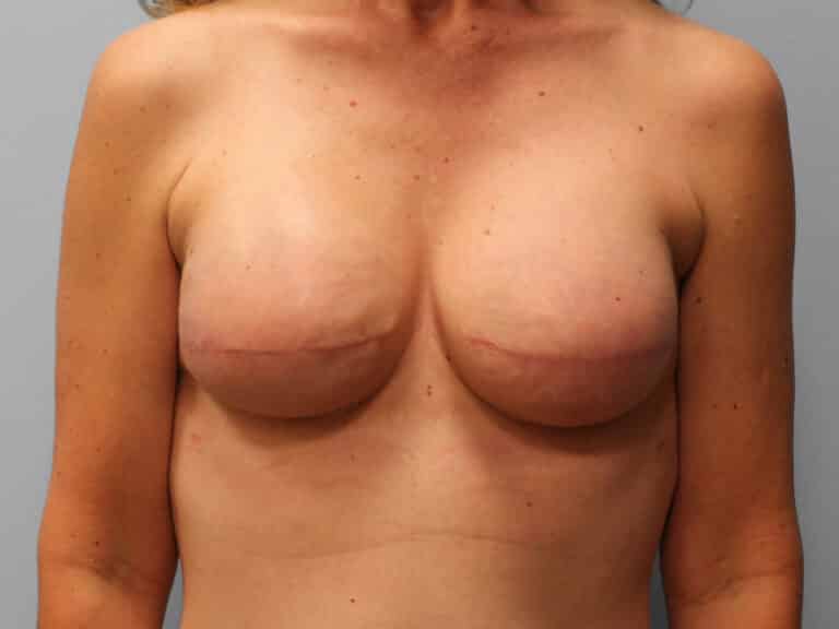 After Image: Breast Reconstruction – Dr. Tucker - front