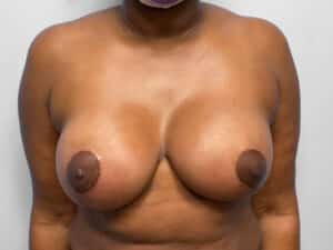 After Image: Breast Augmentation & Lift – Dr. Tucker