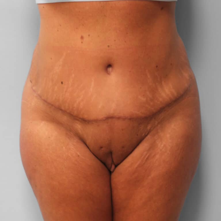 After Image: Tummy Tuck & Lipo – Dr. Tucker - front