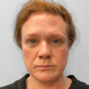 After Image: Upper Blepharoplasty – Dr. Tucker