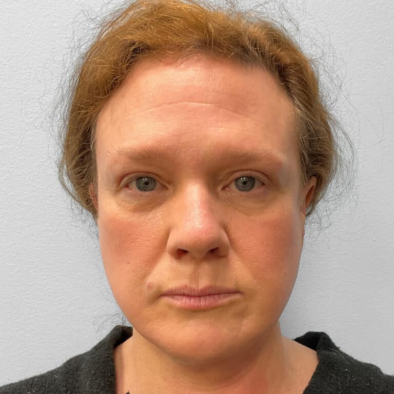 After Image: Upper Blepharoplasty – Dr. Tucker - front