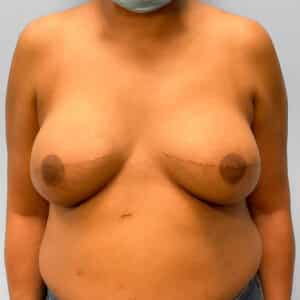 After Image: Breast Reconstruction – Dr. Tucker