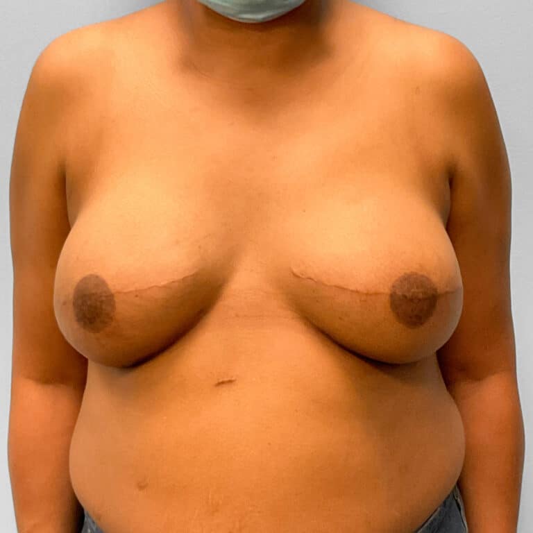 After Image: Breast Reconstruction – Dr. Tucker - front