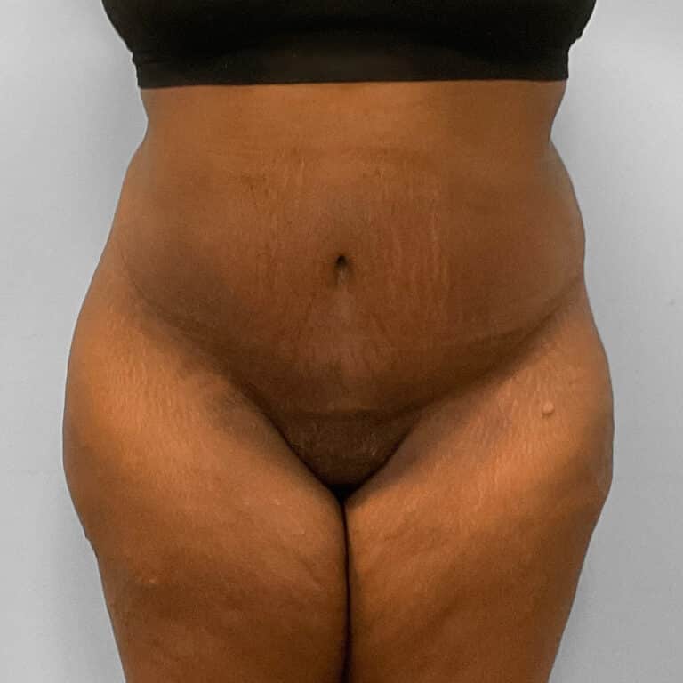After Image: Abdominoplasty & Lipo – Dr. Tucker - front