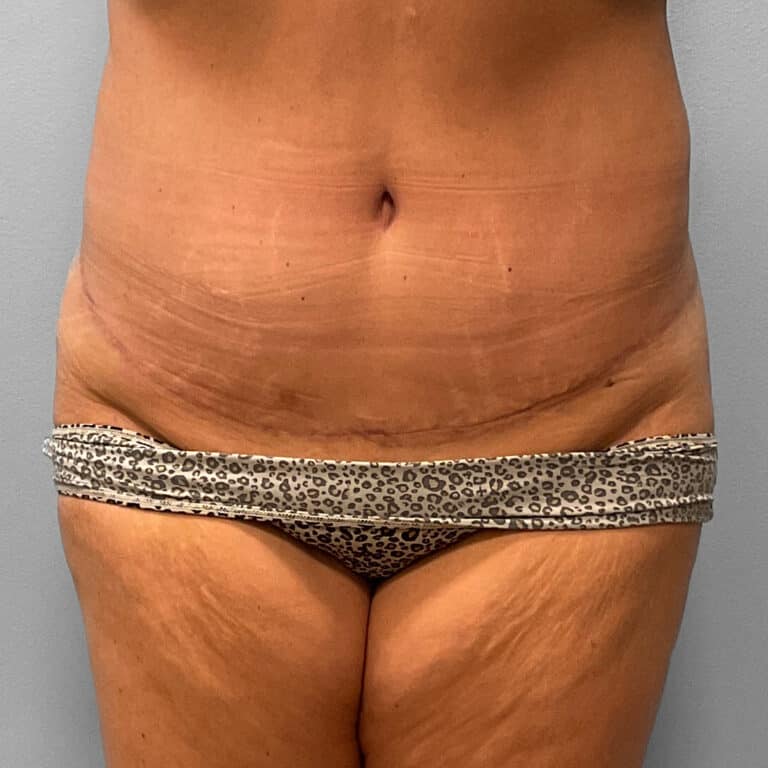 After Image: Tummy Tuck & Lipo – Dr. Tucker - front