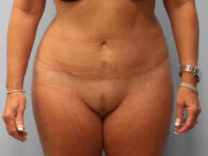 After Image: Abdominoplasty & Lipo – Dr. Tucker