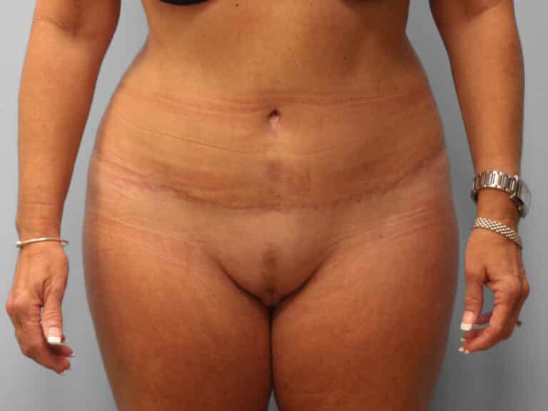 After Image: Abdominoplasty & Lipo – Dr. Tucker - front