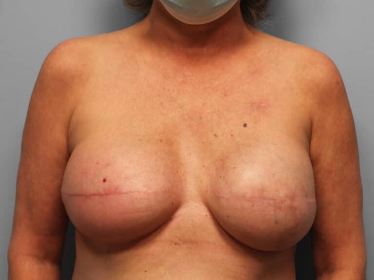 After Image: Breast Reconstruction – Dr. Tucker - front