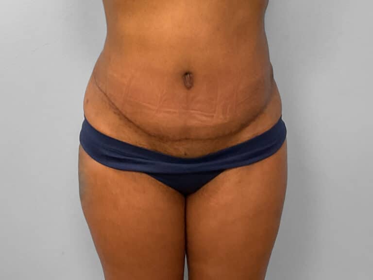 After Image: Tummy Tuck & Lipo – Dr. Tucker - front