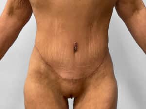 After Image: Body Lift – Dr. Tucker