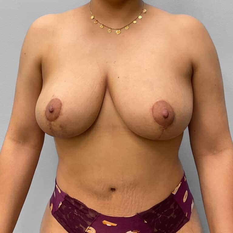 After Image: Breast Lift & Implant Removal – Dr. Tucker - front