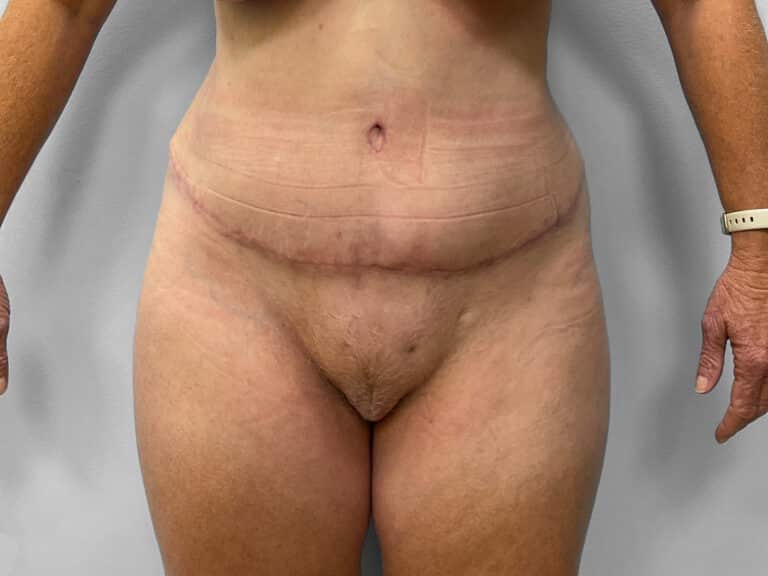 After Image: Tummy Tuck & Lipo – Dr. Tucker - front