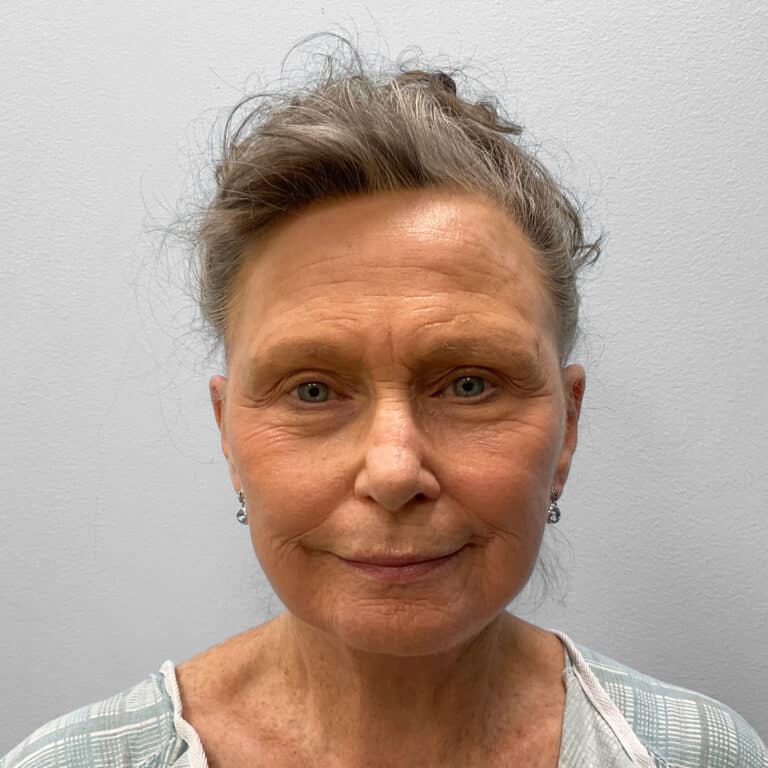After Image: Facelift – Dr. Tucker - front