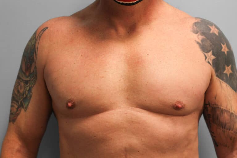 After Image: Gynecomastia Surgery – Dr. Tucker - front