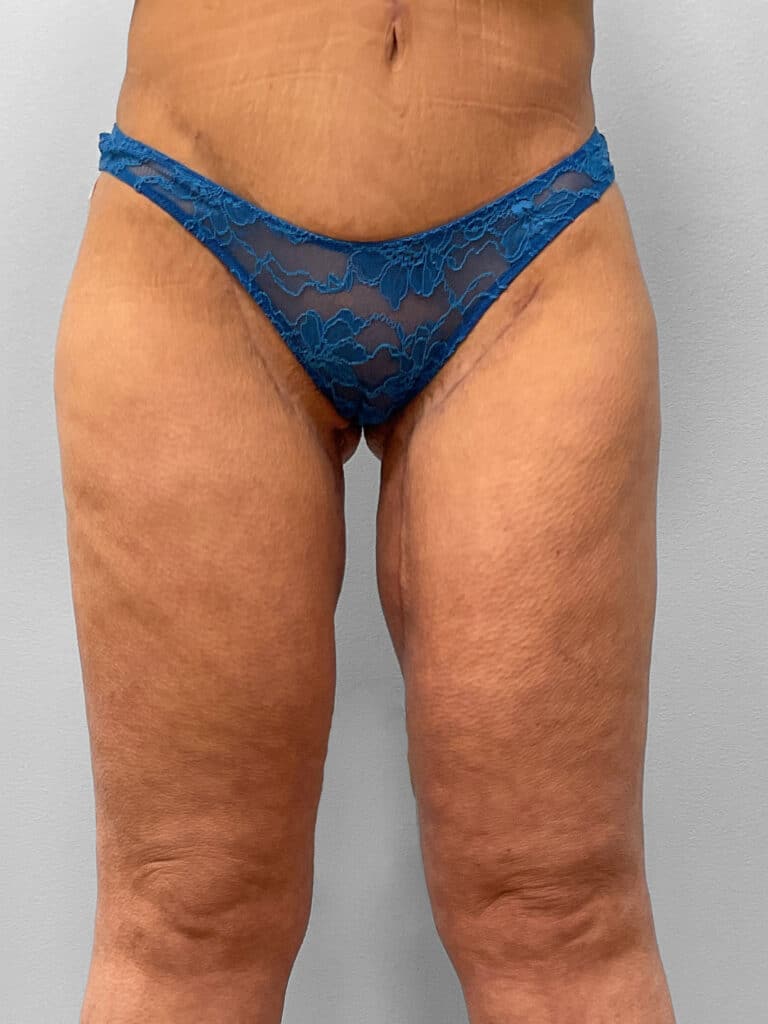 After Image: Medial Thigh Lift – Dr. Tucker - front