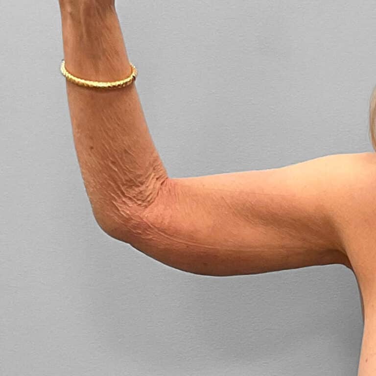 After Image: Arm Lift – Dr. Tucker - front