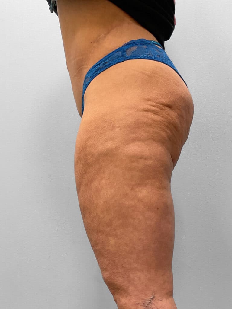 After Image: Medial Thigh Lift – Dr. Tucker - left-side