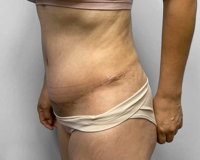 After Image: Tummy Tuck, BBL, & Lipo – Dr. Tucker - left-front-oblique