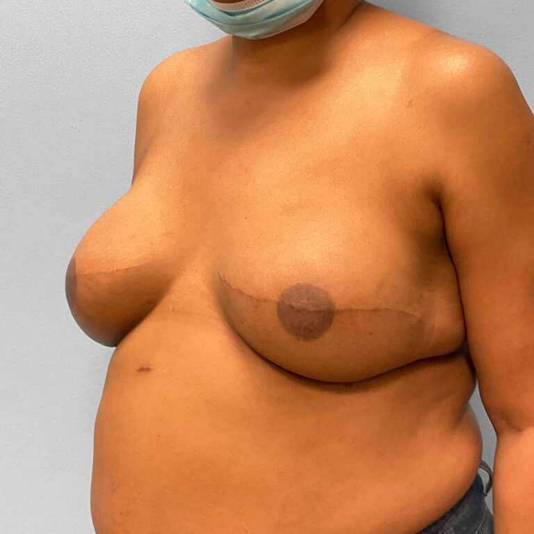 After Image: Breast Reconstruction – Dr. Tucker - left-front-oblique