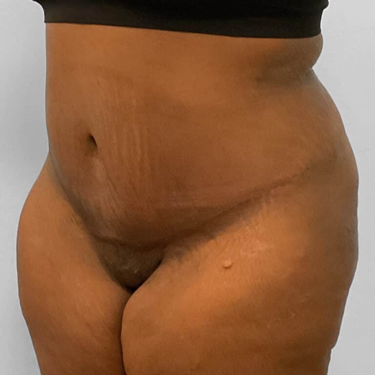 After Image: Abdominoplasty & Lipo – Dr. Tucker - left-front-oblique