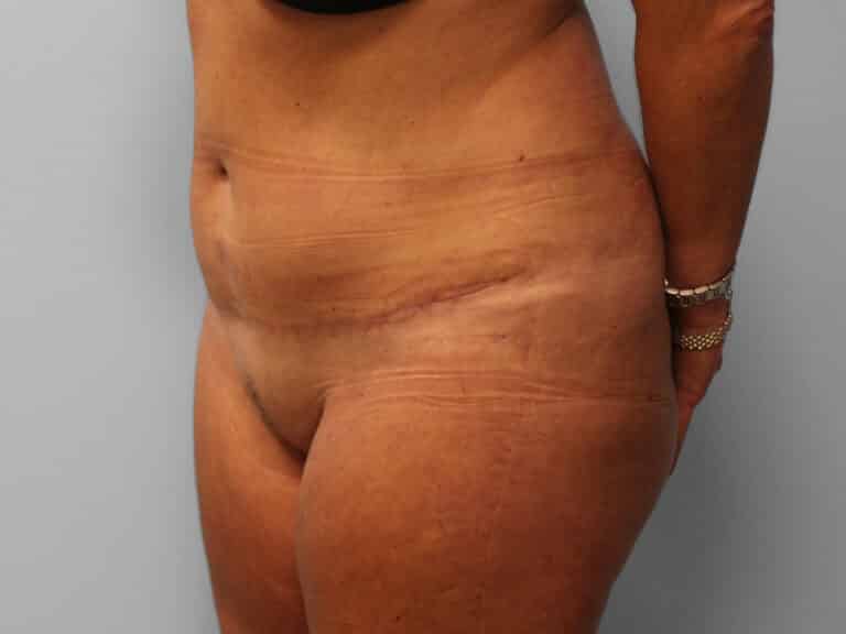 After Image: Abdominoplasty & Lipo – Dr. Tucker - left-front-oblique