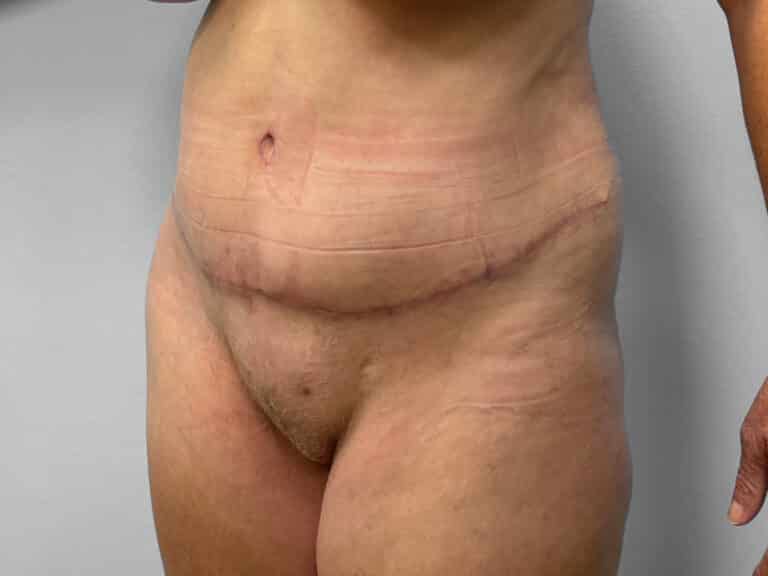 After Image: Tummy Tuck & Lipo – Dr. Tucker - left-front-oblique