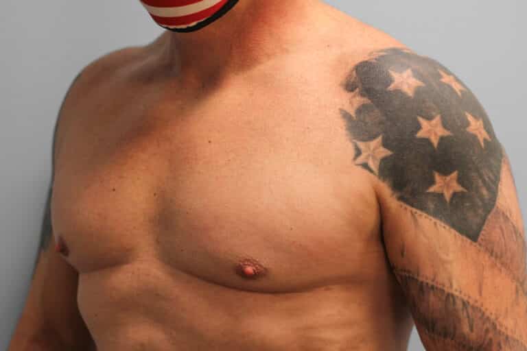 After Image: Gynecomastia Surgery – Dr. Tucker - left-front-oblique