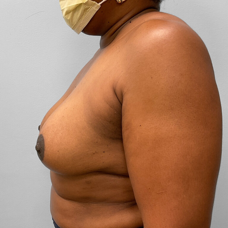 After Image: Breast Augmentation – Dr. Tucker - left-side