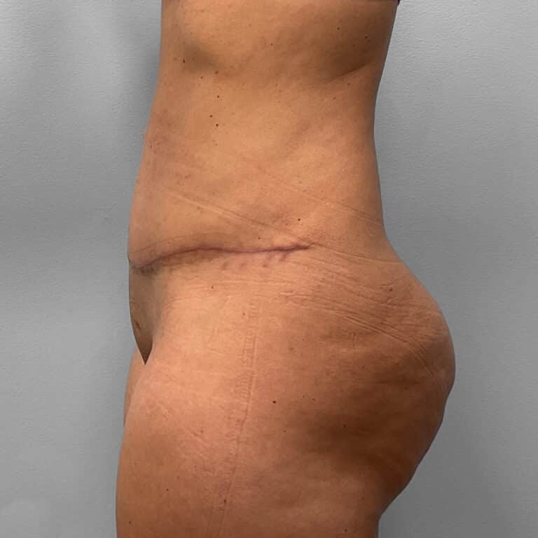 After Image: Tummy Tuck & Lipo – Dr. Tucker - left-side