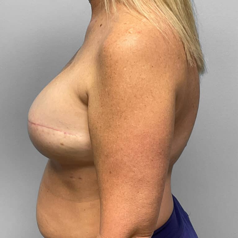After Image: Breast Reconstruction – Dr. Tucker - left-side